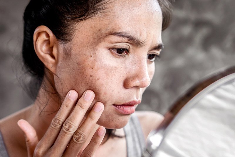 Kako prirodno smanjiti pigmentaciju i tamne pjege